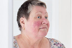 Rosacea, facial skin disorder, portrait of unhappy elderly woman ...